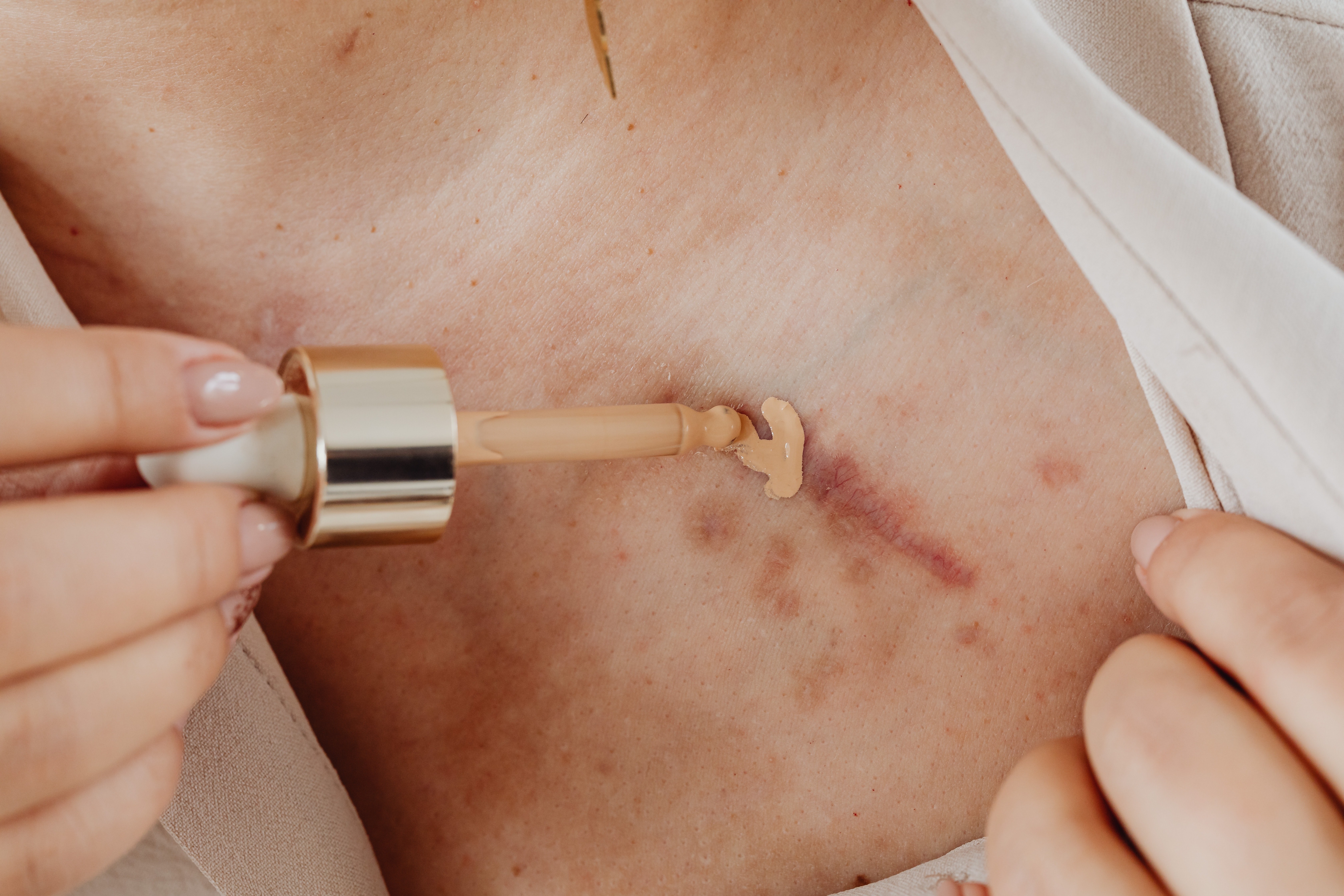 Comment se débarrasser de ses cicatrices ?